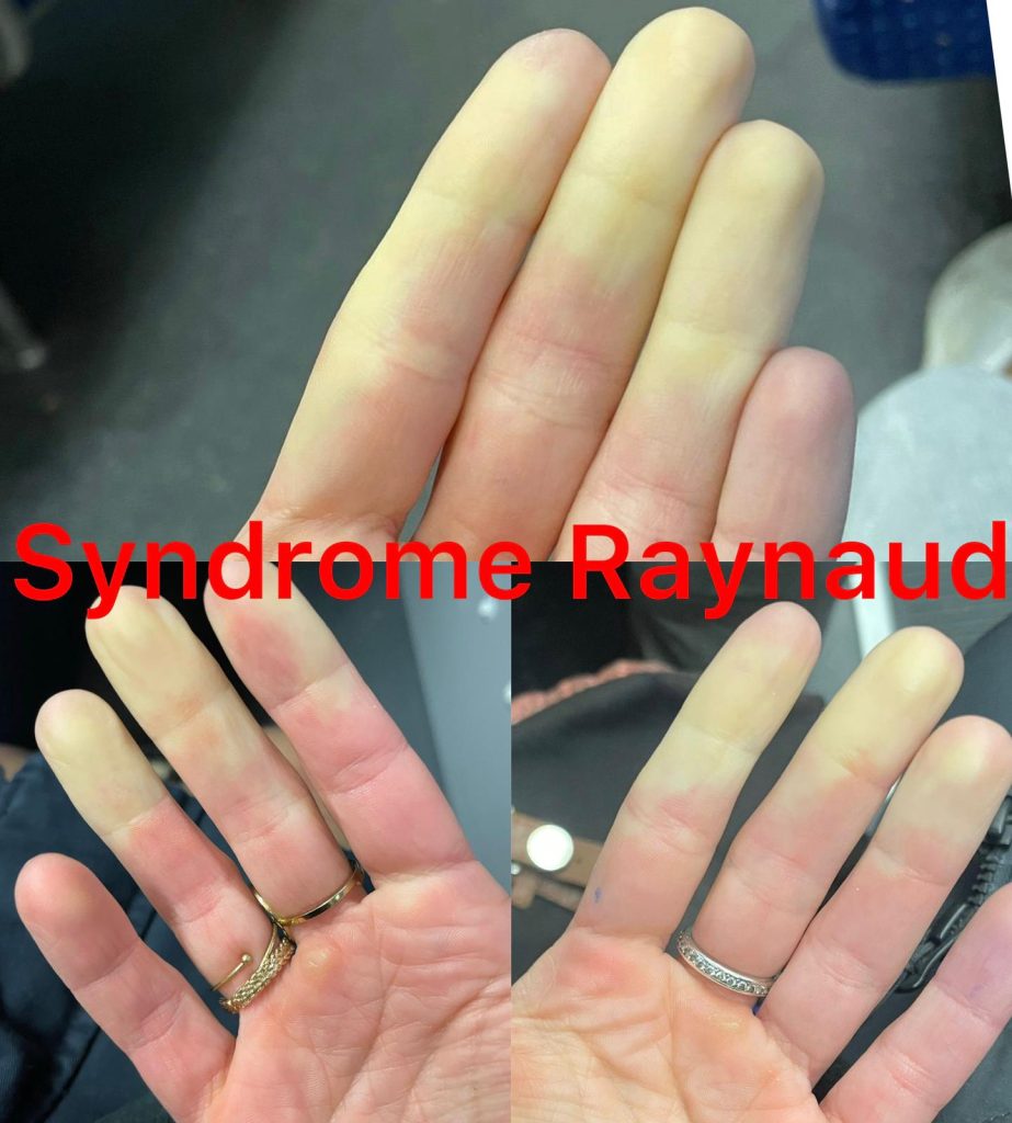 syndrome-reynaud-apres